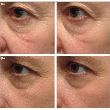 tratamente anti-imbatranire dermatologica pentru ochi