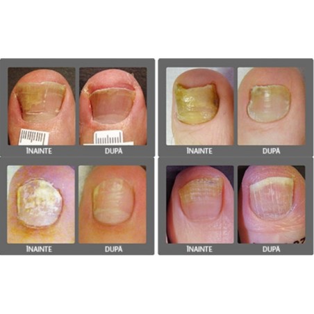 tipuri de ciuperci ale unghiilor și tratament