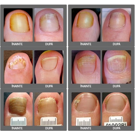 Fungi-Nail - Onychomycosis treatment - 1x bottle - 2 months