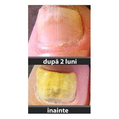 16 remedii casnice pentru ciuperca unghiilor de la picioare - Educație Sanitară | Septembrie 