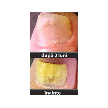Fungi-Nail - Tratament Onicomicoza - 2x flacoane - 4 luni