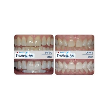 benzi crest whitestrips supreme professional