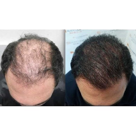 10% Minoxidil Solution - Tugain - 1 Month Treatment - 60ml (pipette and spray included)